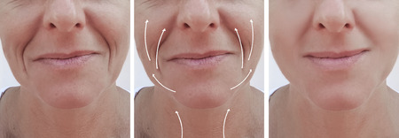 woman face wrinkles correction before and after procedures, arrow