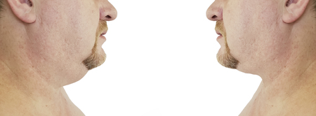 submental fat man before and after proceduresの写真素材
