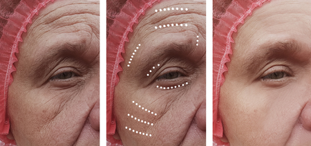 wrinkles before and after proceduresの写真素材
