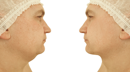 male double chin before and after proceduresの写真素材