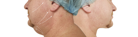 male double chin tightening before and after procedures