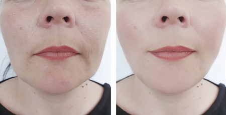 face woman wrinkles before and after procedures