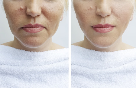 woman's wrinkles face before and afterの写真素材