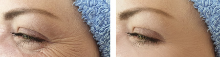 face woman wrinkles before and after proceduresの写真素材