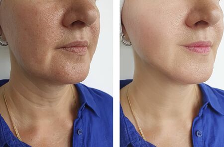 woman wrinkles before and after treatment