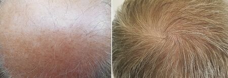 male baldness before and after treatment medicine