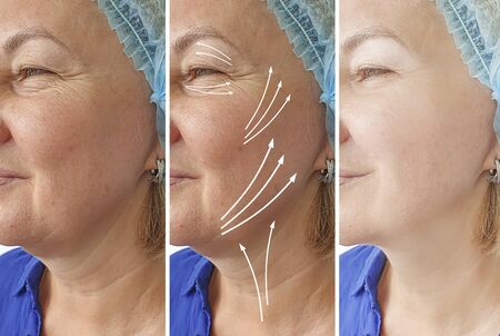 wrinkles woman face before and after treatment