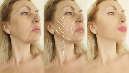 wrinkles woman face before and after treatment