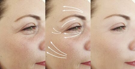 wrinkles woman face before and after treatment