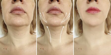 wrinkles woman face before and after treatmentの写真素材
