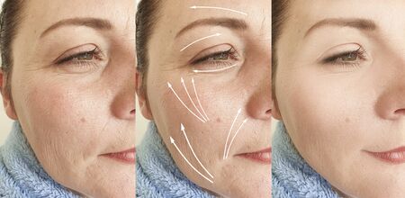 wrinkles woman face before and after treatment