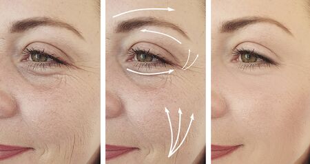 wrinkles woman face before and after treatmentの写真素材