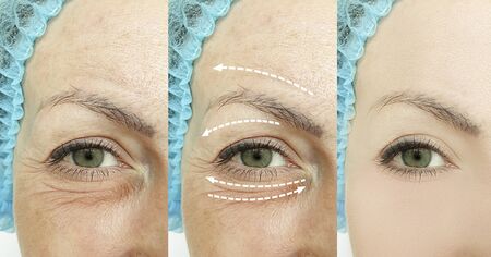 woman eyes wrinkles before and after treatmentの写真素材