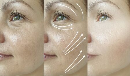 woman wrinkles before and after treatment