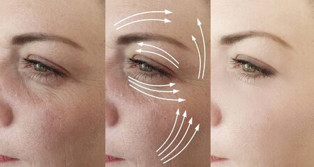 woman face wrinkles before and after treatment