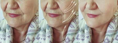 woman wrinkles face before and after treatment arrow