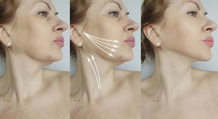 woman face wrinkles before and after treatment, thread lifting