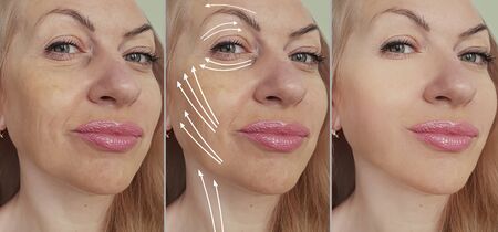 woman face wrinkles before and after treatment