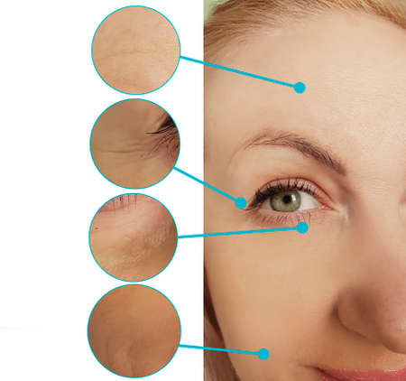 woman face wrinkles before and after collage treatment