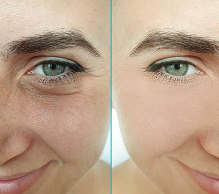 woman face wrinkles before and after treatment
