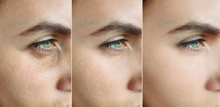 woman face wrinkles before and after treatment collageの写真素材