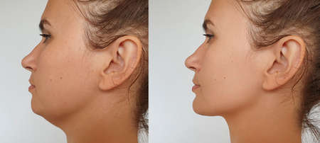 Double chin in women before and after treatment