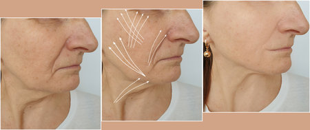 woman face wrinkles before and after treatment