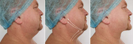man double chin before and after treatment