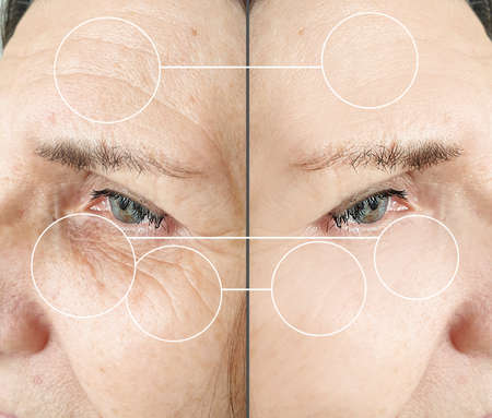 woman face wrinkles before and after treatment