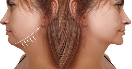 woman double chin before and after treatmentの写真素材