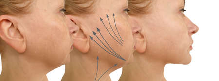 woman double chin before and after treatment