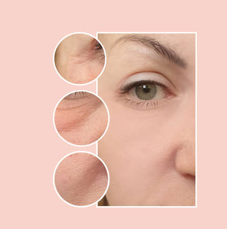 woman face wrinkles before and after treatment
