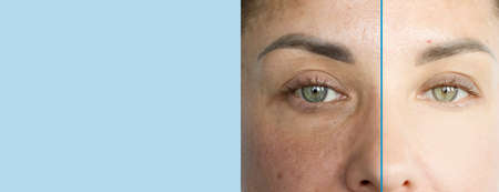 woman eyes wrinkles before and after treatment