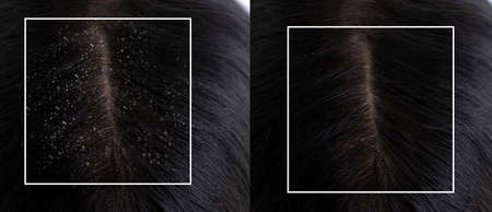 dandruff on the hair before and after treatment