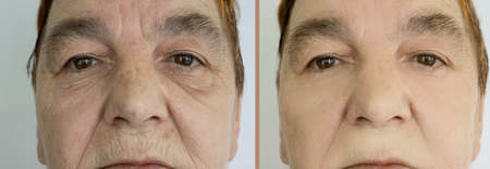 Woman face wrinkles before and after treatment