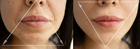 woman face wrinkles before and after treatment
