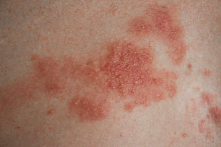 Eczema disease on the skin close up