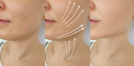 woman double chin before and after treatment