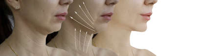 woman double chin before and after treatment
