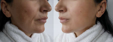 Woman double chin before and after treatment