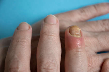Paronychia disease of the fingernailの写真素材