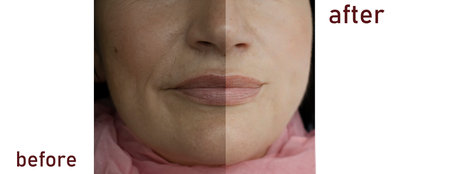 Face wrinkles before and after treatment