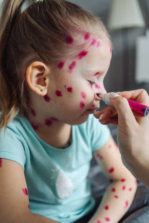 Little girl ill with chickenpox at home