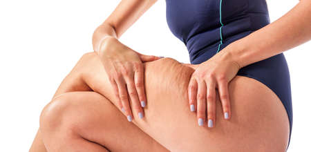 Cellulite and loose skin.の写真素材