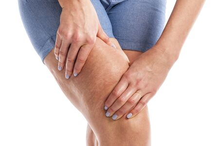 Fat and cellulite on the legs.の写真素材