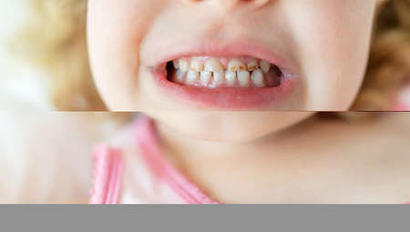 Caries in childrens teeth. Initial stage.の写真素材