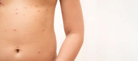 Close-up of naked body Chickenpox disease, Little girl ill with chickenpox on white background. Chickenpox virus, chickenpox outbreak in children. Concept of contagion.の写真素材