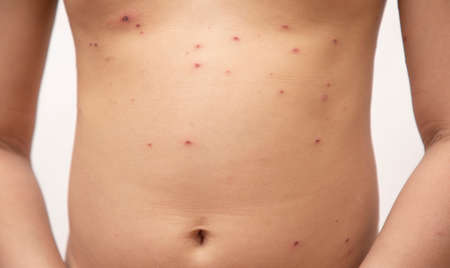Close-up of naked body Chickenpox disease, Little girl ill with chickenpox on white background. Chickenpox virus, chickenpox outbreak in children. Concept of contagion.の写真素材
