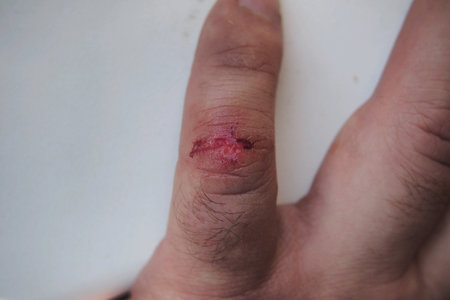 The wound on the little finger.