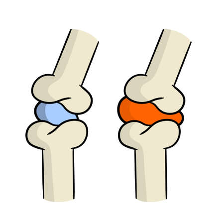Arthritis. Disease of joints. Bones and interosseous cartilage. Biology and anatomy. Medical education and surgery. Red sore spot. Cartoon illustrationのイラスト素材